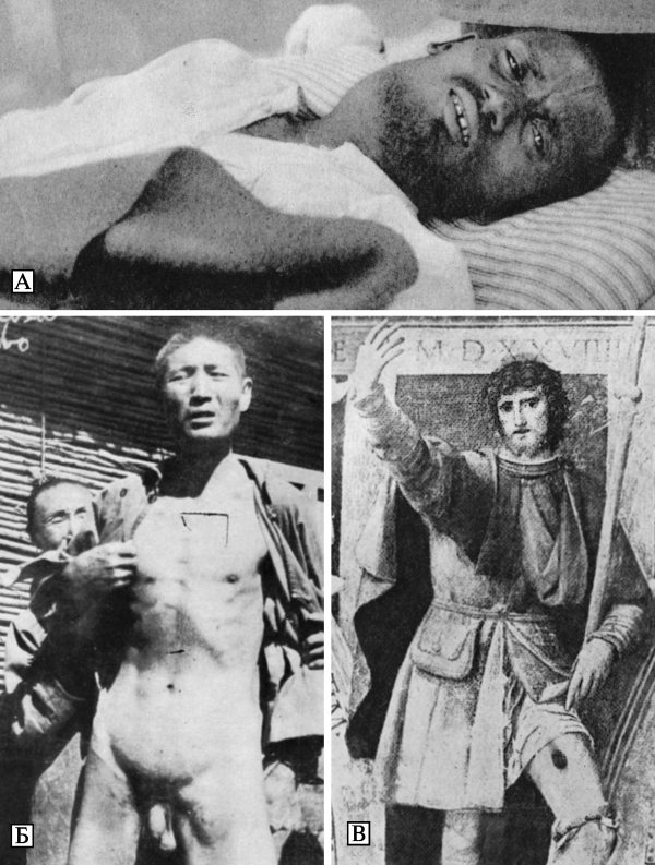 Бубоны у больных чумой