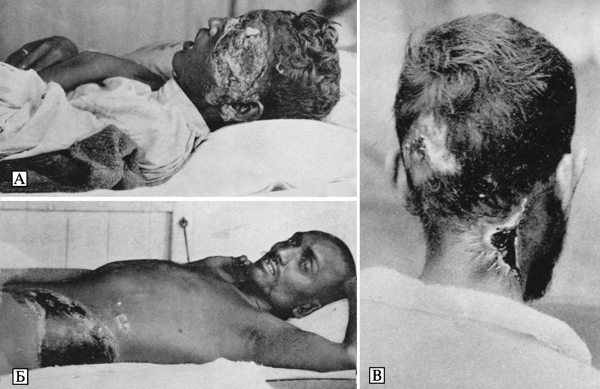 Характерные изъязвления кожи больных бубонной чумой
