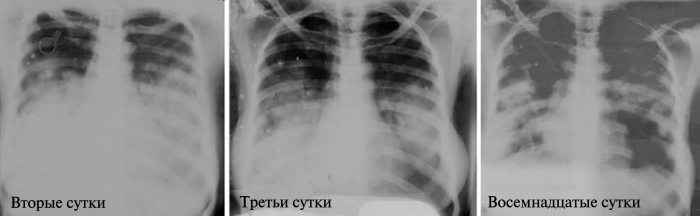 Рентгенологическое исследование грудной клетки больной с первичной легочной чумой