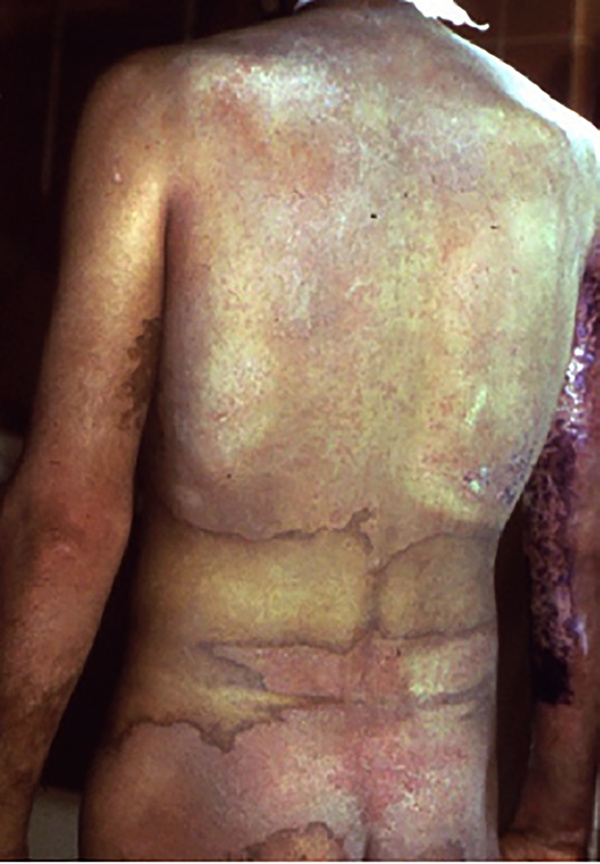 .Рисунок 4 - Иранский военнослужащий после воздействия пара сернистого сернистого иприта. Типичные гипо- и гиперпигментированные участки на спине. В области пояса кожа была защищена ремнем [11]